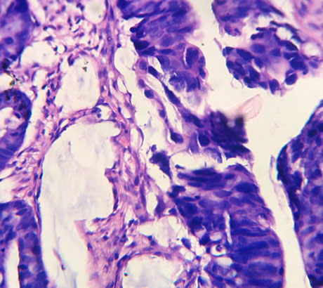 Adenocarcinoma, anal canal