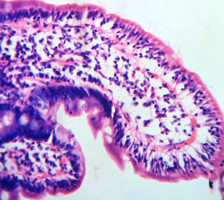 D2 biopsy, coeliac disease: intraepithelial lymphocytes