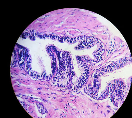 Prostate: hyperplasia and myoepithelial cells