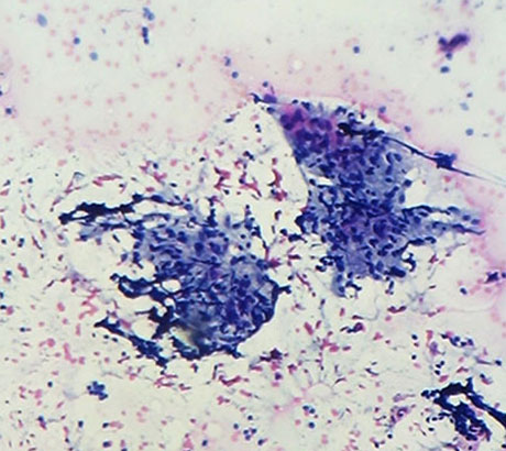 Epithelioid granulomas in tuberculosis