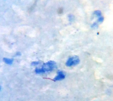 M. tuberculosis in FNAC