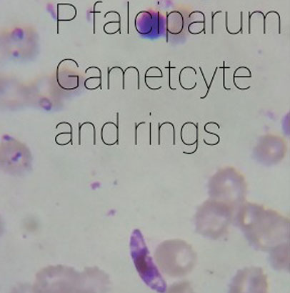Malaria: P. falciparum