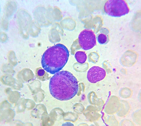 Megaloblast (marrow)