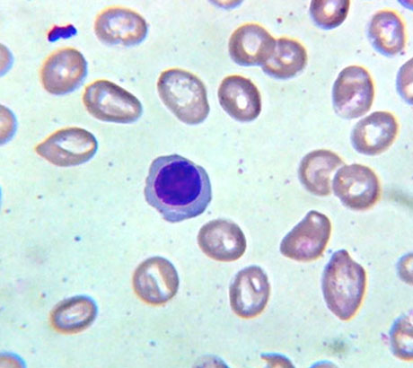 Normoblast (nucleated RBC)